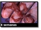 Foto de um aborto - 8 semanas