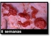 Foto de um aborto - 8 semanas